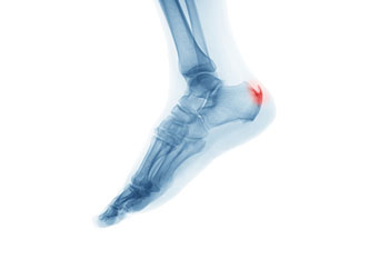 heel spur