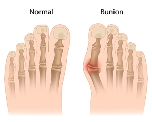 Definiton and Risk Factors for Bunions