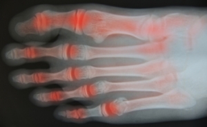 Stretches and Exercises to Relieve Foot Arthritis